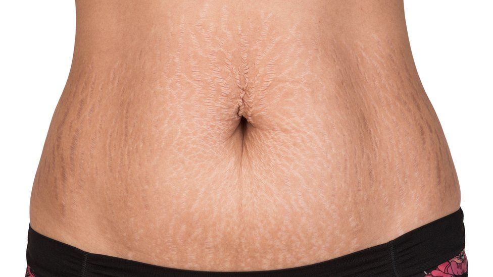 estrías en abdomen